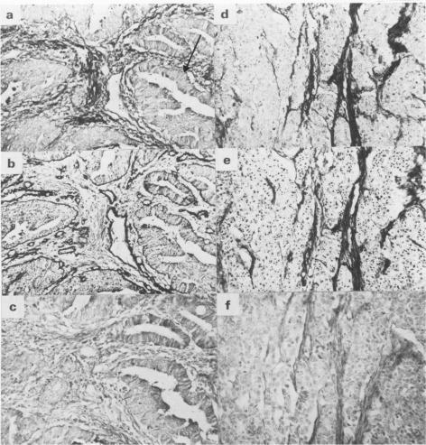 https://cdn.ncbi.nlm.nih.gov/pmc/blobs/4618/1976915/3f7b81ad3cf0/brjcancer00105-0058-a.jpg