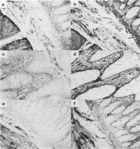 https://cdn.ncbi.nlm.nih.gov/pmc/blobs/4618/1976915/e995dd3990fc/brjcancer00105-0055-a.jpg