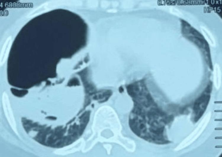 https://cdn.ncbi.nlm.nih.gov/pmc/blobs/4668/12049740/02fa0447c987/cureus-0017-00000081628-i03.jpg