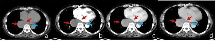 https://cdn.ncbi.nlm.nih.gov/pmc/blobs/4677/11164569/e025ef7b4648/cureus-0016-00000060109-i02.jpg