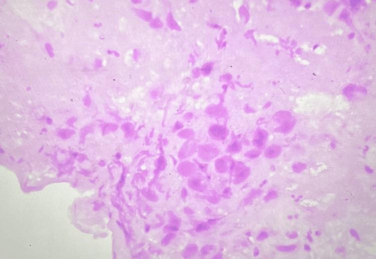 https://cdn.ncbi.nlm.nih.gov/pmc/blobs/4698/10868712/7c32a8552d21/cureus-0016-00000052388-i04.jpg