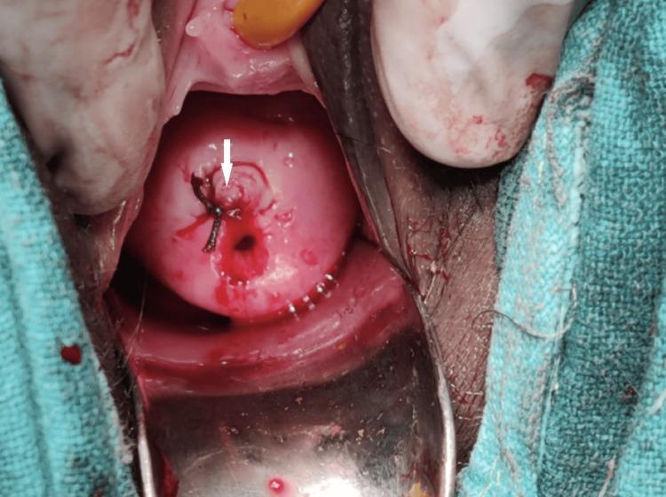 https://cdn.ncbi.nlm.nih.gov/pmc/blobs/4698/10868712/d154f14d2322/cureus-0016-00000052388-i03.jpg