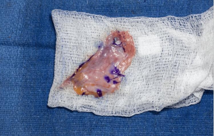 https://cdn.ncbi.nlm.nih.gov/pmc/blobs/46af/11463822/05380cb8cc04/cureus-0016-00000068949-i03.jpg