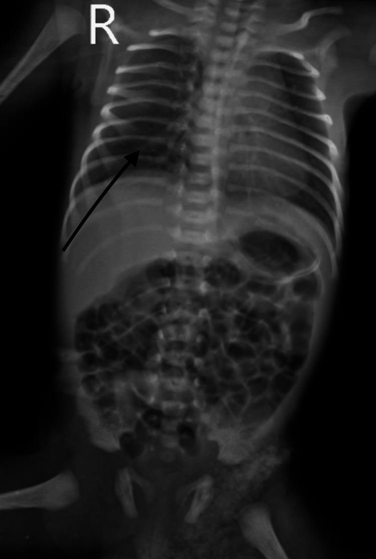 https://cdn.ncbi.nlm.nih.gov/pmc/blobs/46b3/11326758/71ecb93bc38b/cureus-0016-00000064656-i01.jpg