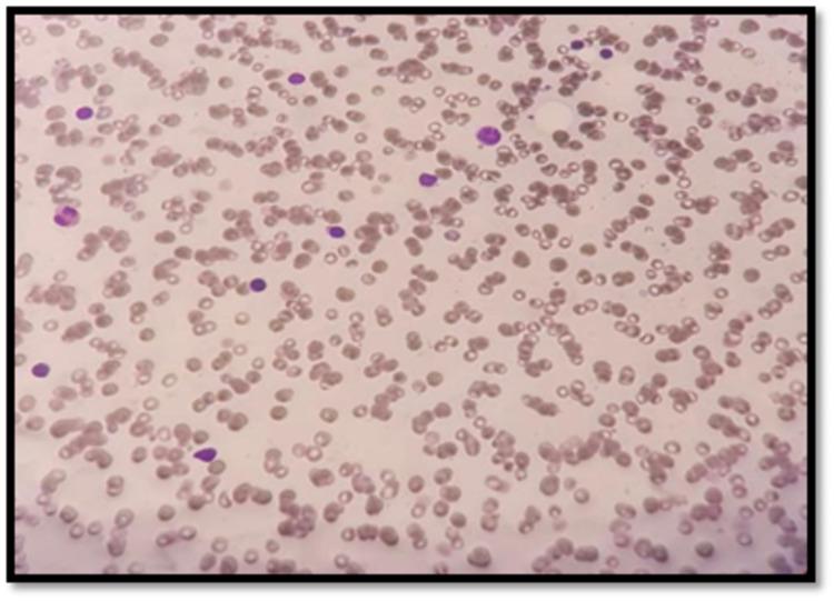 https://cdn.ncbi.nlm.nih.gov/pmc/blobs/472f/8723724/2cd0d0248675/cureus-0013-00000020135-i02.jpg