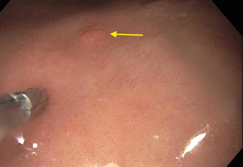 https://cdn.ncbi.nlm.nih.gov/pmc/blobs/47b7/6504030/5c8978b4d602/cureus-0011-00000004193-i02.jpg