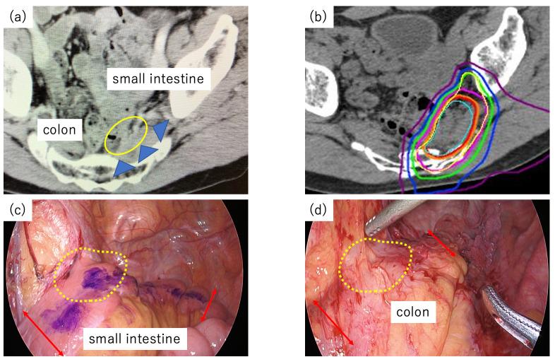 https://cdn.ncbi.nlm.nih.gov/pmc/blobs/47e0/12249107/9fd384160734/cancers-17-02230-g002.jpg