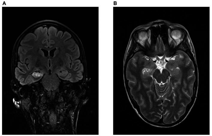 https://cdn.ncbi.nlm.nih.gov/pmc/blobs/47e8/10486887/5051ece17e35/fneur-14-1225975-g001.jpg