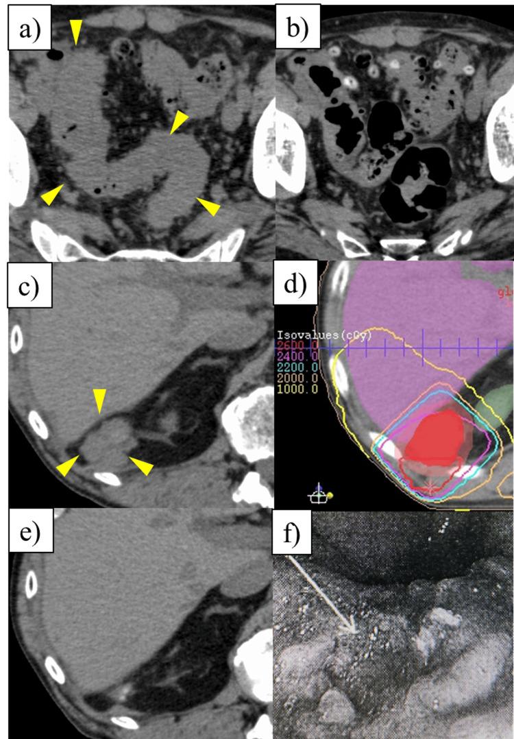 https://cdn.ncbi.nlm.nih.gov/pmc/blobs/4827/11467698/03bc16d8fb2c/cureus-0016-00000069147-i03.jpg