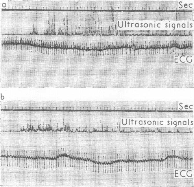 https://cdn.ncbi.nlm.nih.gov/pmc/blobs/4893/470033/64eb8f3fffe7/thorax00129-0030-a.jpg