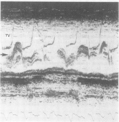 https://cdn.ncbi.nlm.nih.gov/pmc/blobs/48d5/481532/5e309cedd53f/brheartj00124-0103-a.jpg