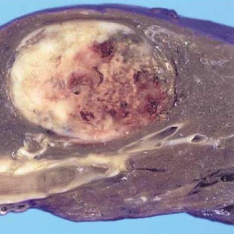 https://cdn.ncbi.nlm.nih.gov/pmc/blobs/48fb/2694395/8198e3021739/jkms-22-S159-g003.jpg