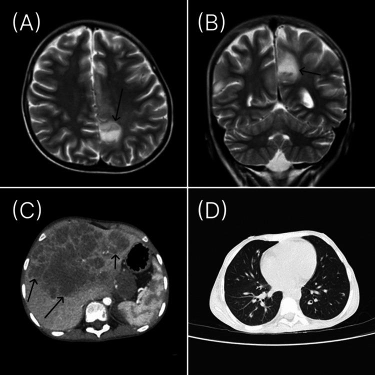https://cdn.ncbi.nlm.nih.gov/pmc/blobs/4931/12026210/d73c37234cdd/cureus-0017-00000081235-i02.jpg