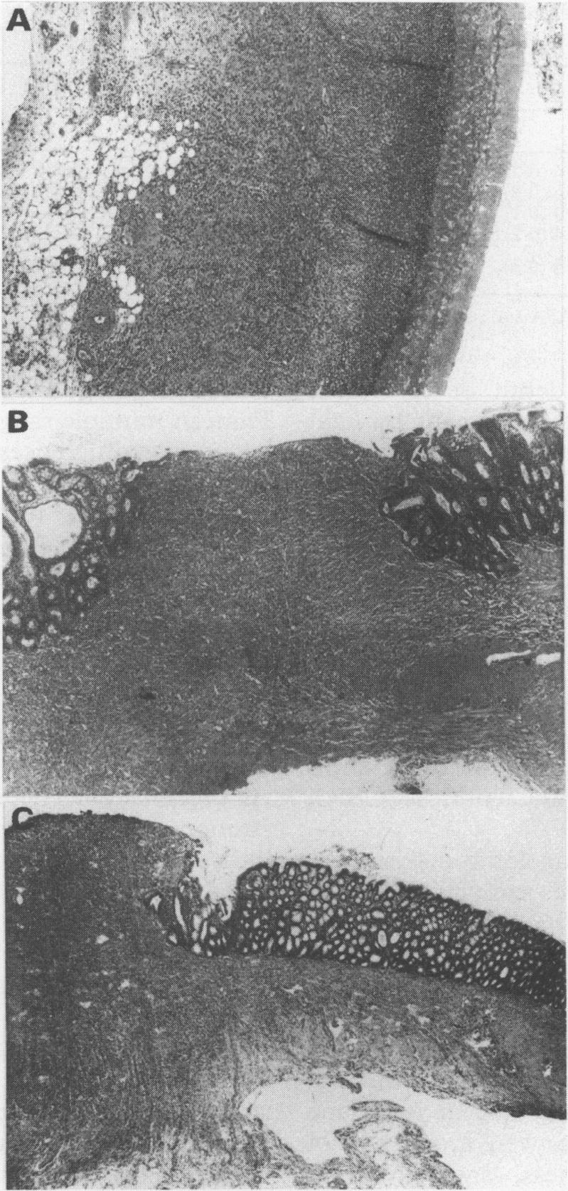 https://cdn.ncbi.nlm.nih.gov/pmc/blobs/4942/1383199/dbfb465a4041/gut00507-0122-a.jpg