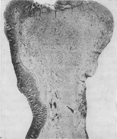 https://cdn.ncbi.nlm.nih.gov/pmc/blobs/499d/1450555/469916390a5e/annsurg01241-0129-a.jpg