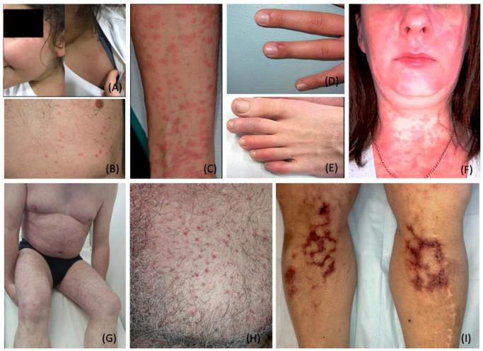 https://cdn.ncbi.nlm.nih.gov/pmc/blobs/49d8/9326733/05a097584869/dermatopathology-09-00027-g002.jpg