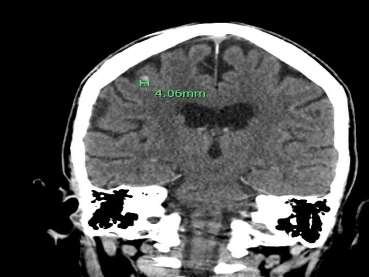 https://cdn.ncbi.nlm.nih.gov/pmc/blobs/4a52/10202005/4dd70c496526/cureus-0015-00000037973-i02.jpg