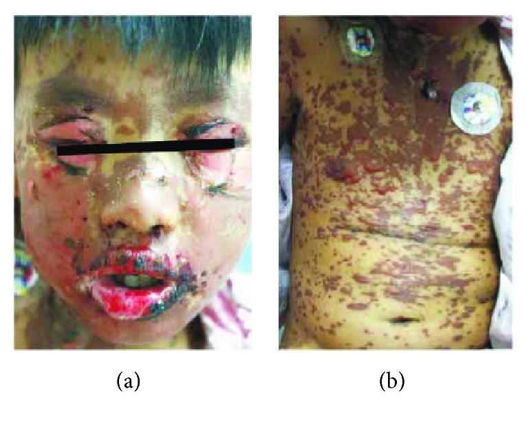 https://cdn.ncbi.nlm.nih.gov/pmc/blobs/4a5d/5828103/eccf46f1c618/JIR2018-4320195.001.jpg
