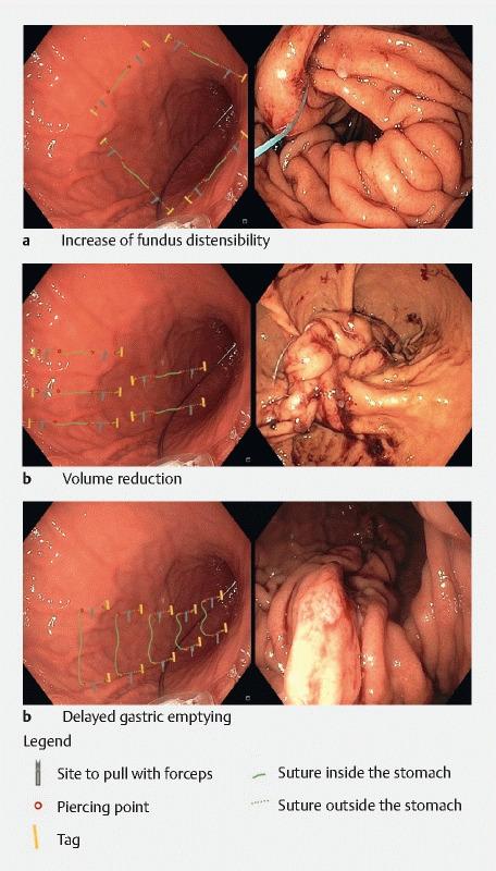https://cdn.ncbi.nlm.nih.gov/pmc/blobs/4b8a/9473843/036474a2e8b5/10-1055-a-1880-7580-i2656ei1.jpg