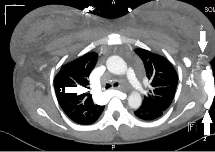 https://cdn.ncbi.nlm.nih.gov/pmc/blobs/4b8d/11150072/85a1f0c051cc/cureus-0016-00000059690-i02.jpg