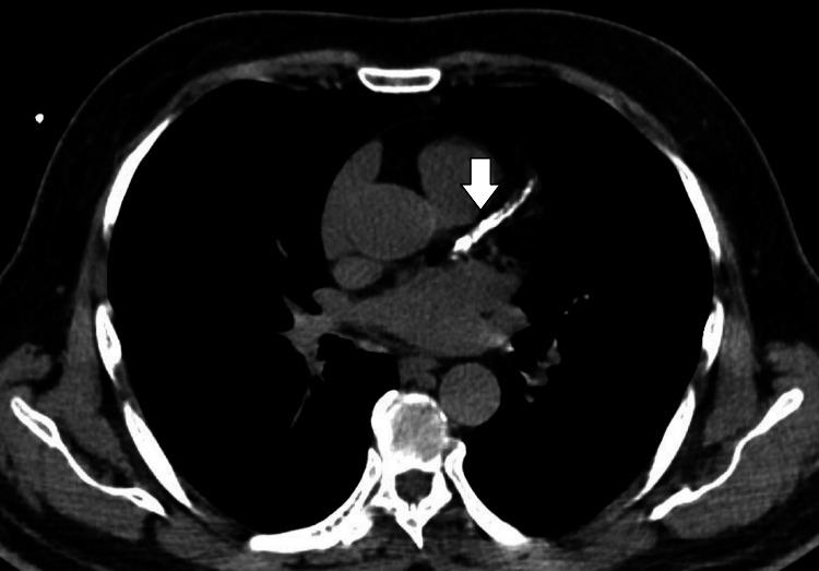 https://cdn.ncbi.nlm.nih.gov/pmc/blobs/4bd0/11151146/692220b39c92/cureus-0016-00000059715-i02.jpg