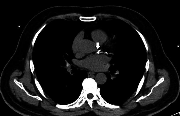 https://cdn.ncbi.nlm.nih.gov/pmc/blobs/4bd0/11151146/f5d665ccfc70/cureus-0016-00000059715-i01.jpg