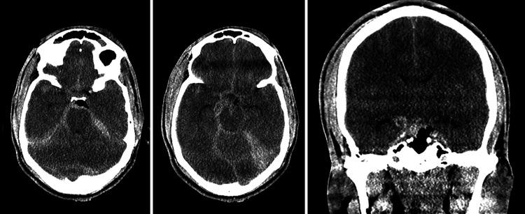 https://cdn.ncbi.nlm.nih.gov/pmc/blobs/4bde/9241346/9ca1815a4802/CASE2053f1.jpg