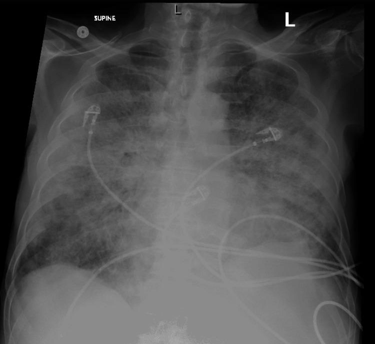 https://cdn.ncbi.nlm.nih.gov/pmc/blobs/4cb6/9365400/9e933567f4f2/cureus-0014-00000026758-i04.jpg