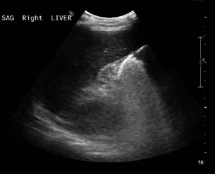 https://cdn.ncbi.nlm.nih.gov/pmc/blobs/4cc2/8916923/22c99bf7f811/cureus-0014-00000022050-i01.jpg