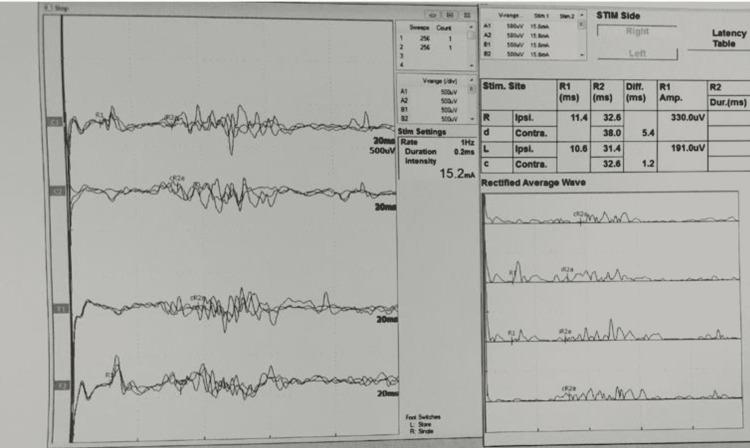 https://cdn.ncbi.nlm.nih.gov/pmc/blobs/4ce2/9200109/99057a303ed7/cureus-0014-00000025047-i01.jpg