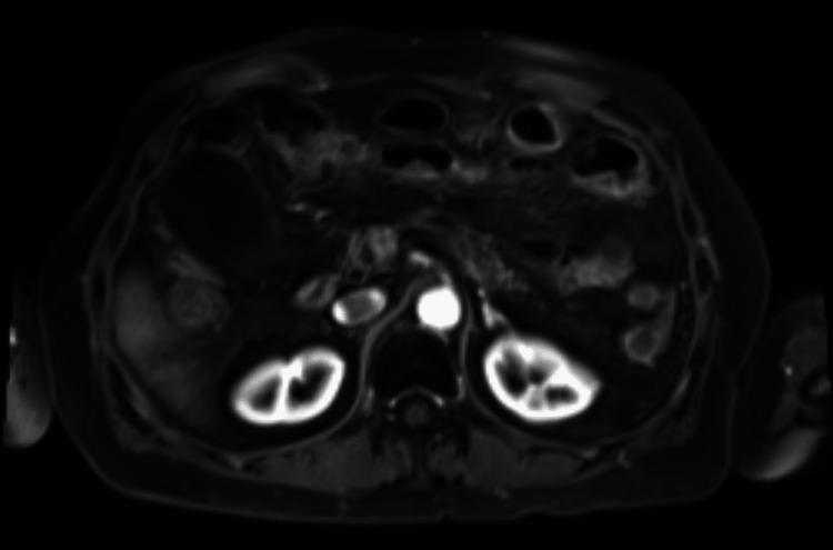 https://cdn.ncbi.nlm.nih.gov/pmc/blobs/4d06/10246730/210f2eae8ede/cureus-0015-00000038716-i04.jpg