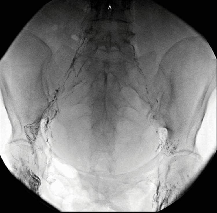 https://cdn.ncbi.nlm.nih.gov/pmc/blobs/4d06/10246730/fec0fb026210/cureus-0015-00000038716-i02.jpg