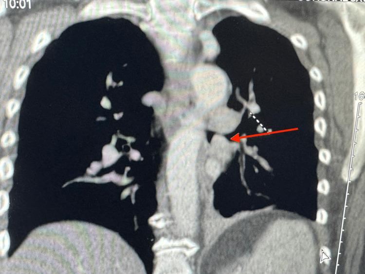 https://cdn.ncbi.nlm.nih.gov/pmc/blobs/4d38/11372752/528ed23e0388/cureus-0016-00000066004-i02.jpg