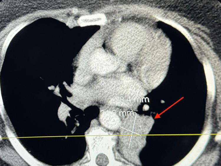 https://cdn.ncbi.nlm.nih.gov/pmc/blobs/4d38/11372752/f5c6f34ecae9/cureus-0016-00000066004-i01.jpg