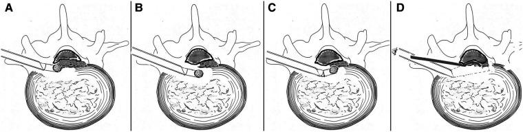 https://cdn.ncbi.nlm.nih.gov/pmc/blobs/4d80/10203165/2145b3e26b25/fsurg-10-1084485-g003.jpg