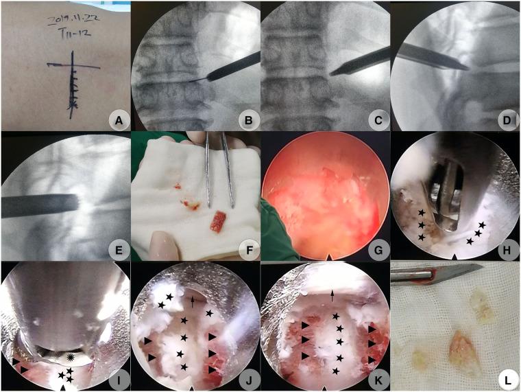 https://cdn.ncbi.nlm.nih.gov/pmc/blobs/4d80/10203165/9b6d4ef9712a/fsurg-10-1084485-g002.jpg