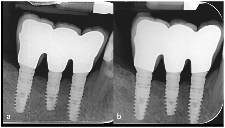 https://cdn.ncbi.nlm.nih.gov/pmc/blobs/4d98/6784736/9816d9346380/dentistry-07-00077-g014.jpg