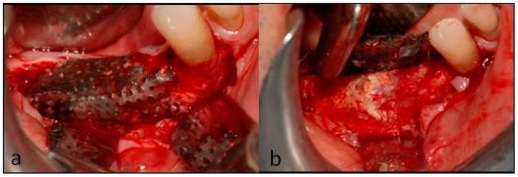 https://cdn.ncbi.nlm.nih.gov/pmc/blobs/4d98/6784736/b3f48e77f045/dentistry-07-00077-g009.jpg