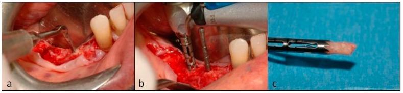 https://cdn.ncbi.nlm.nih.gov/pmc/blobs/4d98/6784736/cc1041c3475f/dentistry-07-00077-g010.jpg