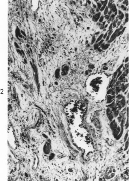 https://cdn.ncbi.nlm.nih.gov/pmc/blobs/4e5c/1942223/f7ad89d6ef5f/amjpathol00355-0082-b.jpg