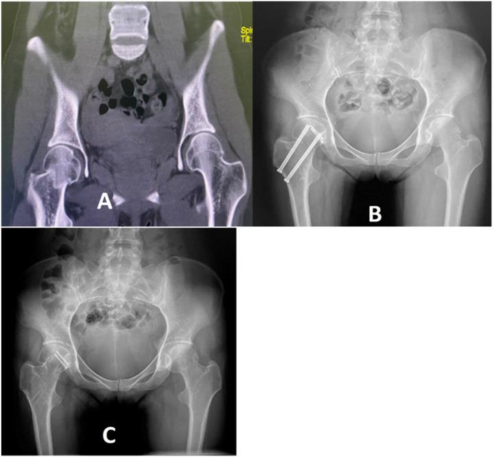 https://cdn.ncbi.nlm.nih.gov/pmc/blobs/4e86/12399708/bf691d7e570c/fsurg-12-1554603-g005.jpg