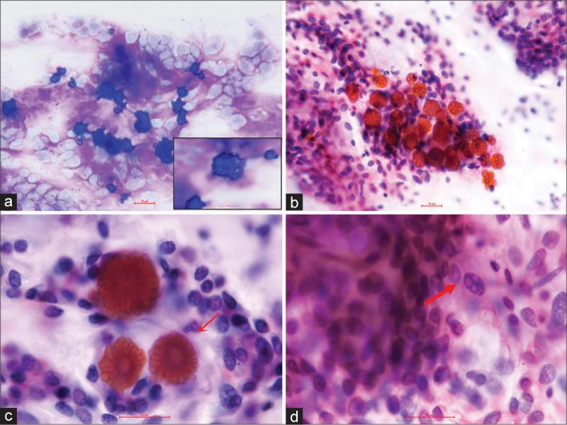 https://cdn.ncbi.nlm.nih.gov/pmc/blobs/4ea6/8248009/a0372d4ea971/Cytojournal-18-13-g001.jpg