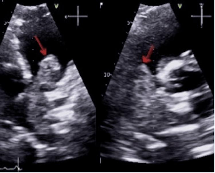https://cdn.ncbi.nlm.nih.gov/pmc/blobs/4ef4/11068079/59a12e25e4c3/cureus-0016-00000057542-i06.jpg