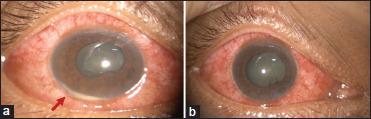 https://cdn.ncbi.nlm.nih.gov/pmc/blobs/4f1f/10697240/32096f03c898/OJO-16-555-g001.jpg
