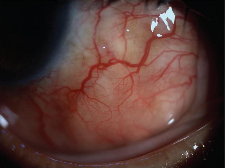 https://cdn.ncbi.nlm.nih.gov/pmc/blobs/4f3b/5565894/5e196737efec/IJO-65-371-g003.jpg