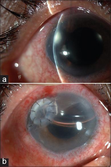 https://cdn.ncbi.nlm.nih.gov/pmc/blobs/4f3b/5565894/c5f9f425acd6/IJO-65-371-g007.jpg