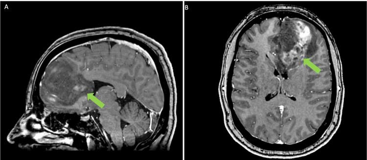 https://cdn.ncbi.nlm.nih.gov/pmc/blobs/4f3e/10914376/d7ffa1954456/cureus-0016-00000053573-i01.jpg