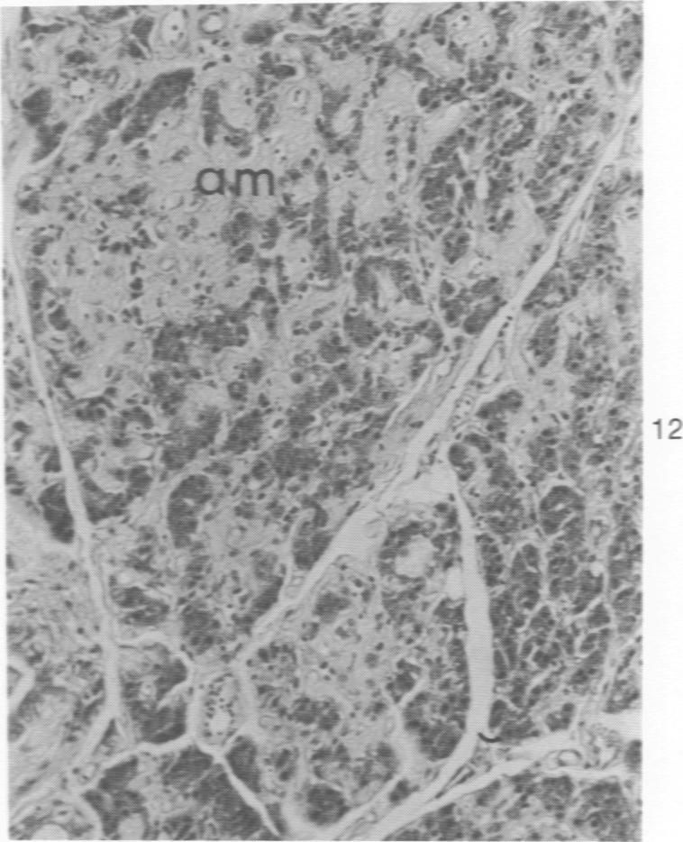 https://cdn.ncbi.nlm.nih.gov/pmc/blobs/4f72/2018582/9683e0113790/amjpathol00735-0043-d.jpg