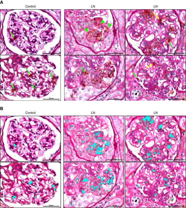 https://cdn.ncbi.nlm.nih.gov/pmc/blobs/4f90/11371349/04315e8f131f/kidney360-5-1154-g009.jpg