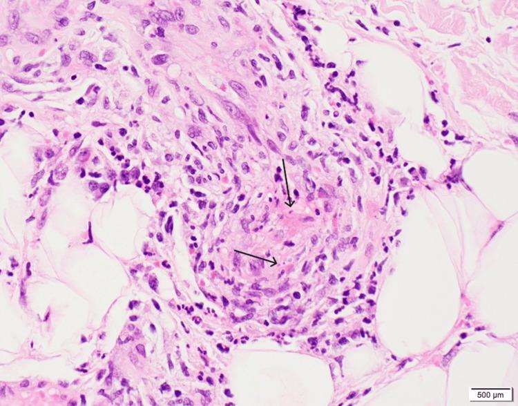 https://cdn.ncbi.nlm.nih.gov/pmc/blobs/4fd3/12085235/d4953996efff/cureus-0017-00000082467-i02.jpg